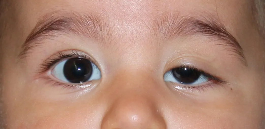 Congenital eyelid ptosis - Miranza